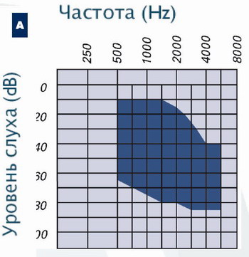Показания для имплантирования активного слухового протеза