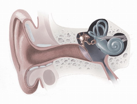 Расширение (гидропс) перепончатого лабиринта внутреннего уха
