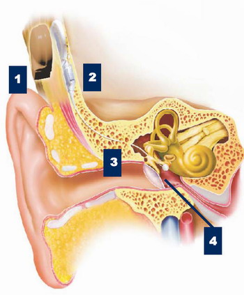 КОХЛЕАРНАЯ ИМПЛАНТАЦИЯ в ГЕРМАНИИ - схема установки слухового протеза среднего уха
